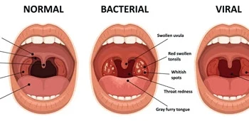 hypertrophy of tonsils icd 10