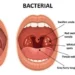 hypertrophy of tonsils icd 10